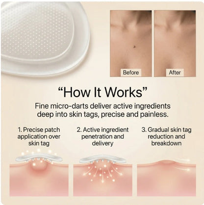 MoleAway™ Skin Tag Remover Patches ❤️🩹 | Buy 1 Get 1 Free ✨